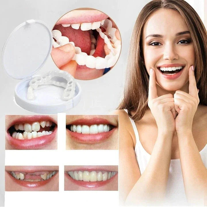 Snap on Smile Veneers (oben und unten)