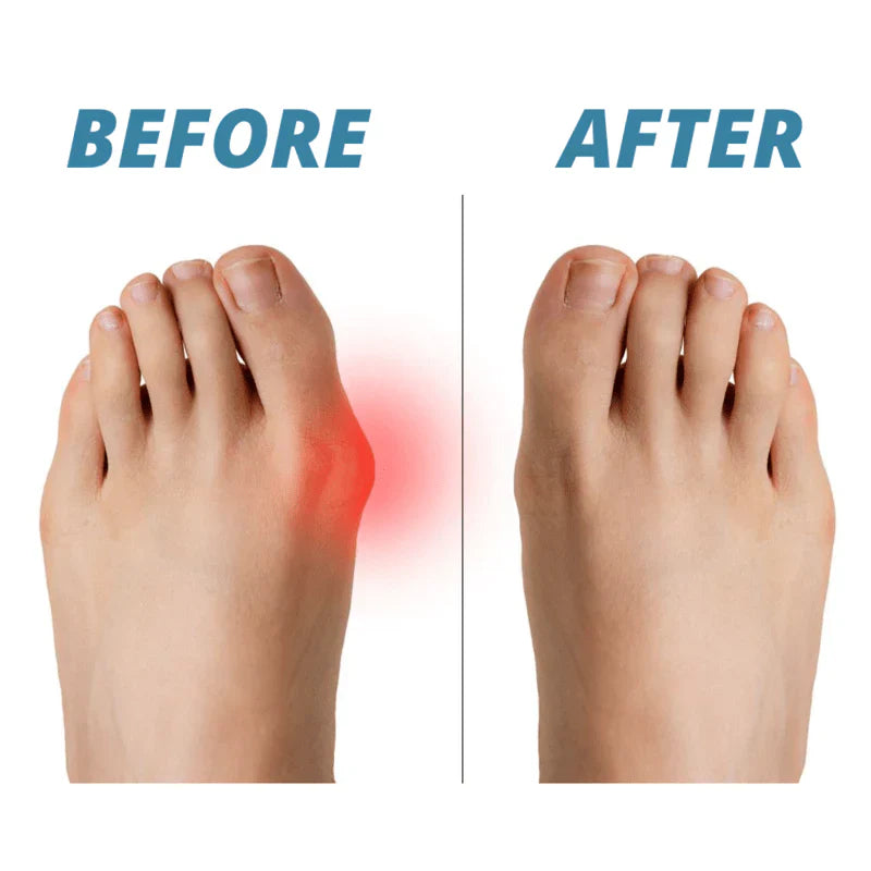 Premium Bunion Corrector Sokker (2PK)