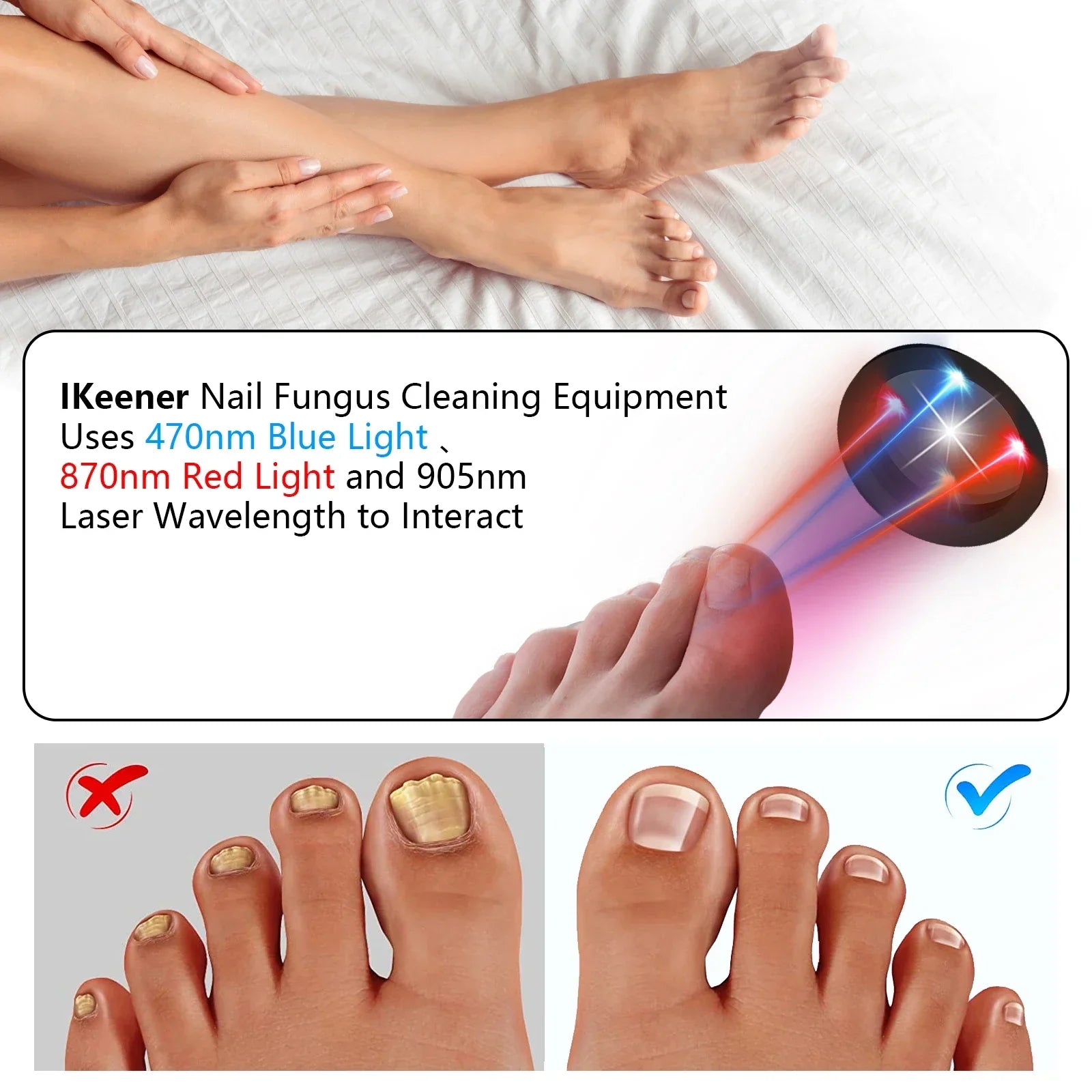 The Anti-Fungal Toenail Laser Therapy Machine with USB Charge